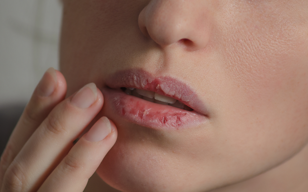 Cara Mudah Atasi Bibir Kering Secara Alami
